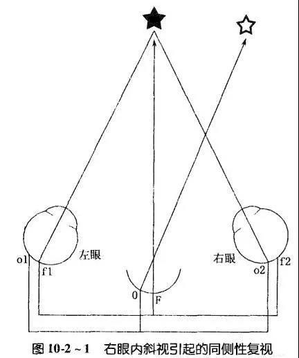 平行光線進入眼內後,由於眼球在不同子午線上屈光力不等,不能聚集於一