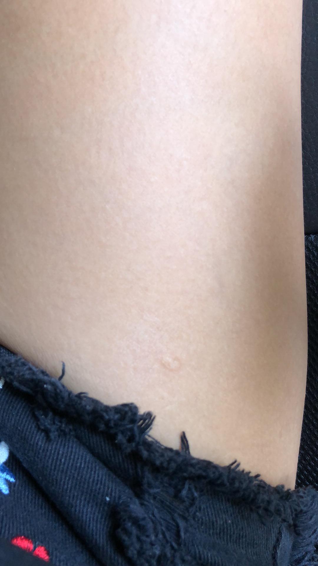 疤痕体质被蚊虫叮咬或者破皮就会留疤怎么办有什么去疤产品比较有用