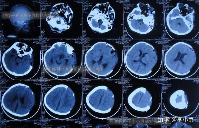 腦膜炎性顱內積膿去骨瓣開顱術後刀口仍流膿意識障礙不能走路轉至神經