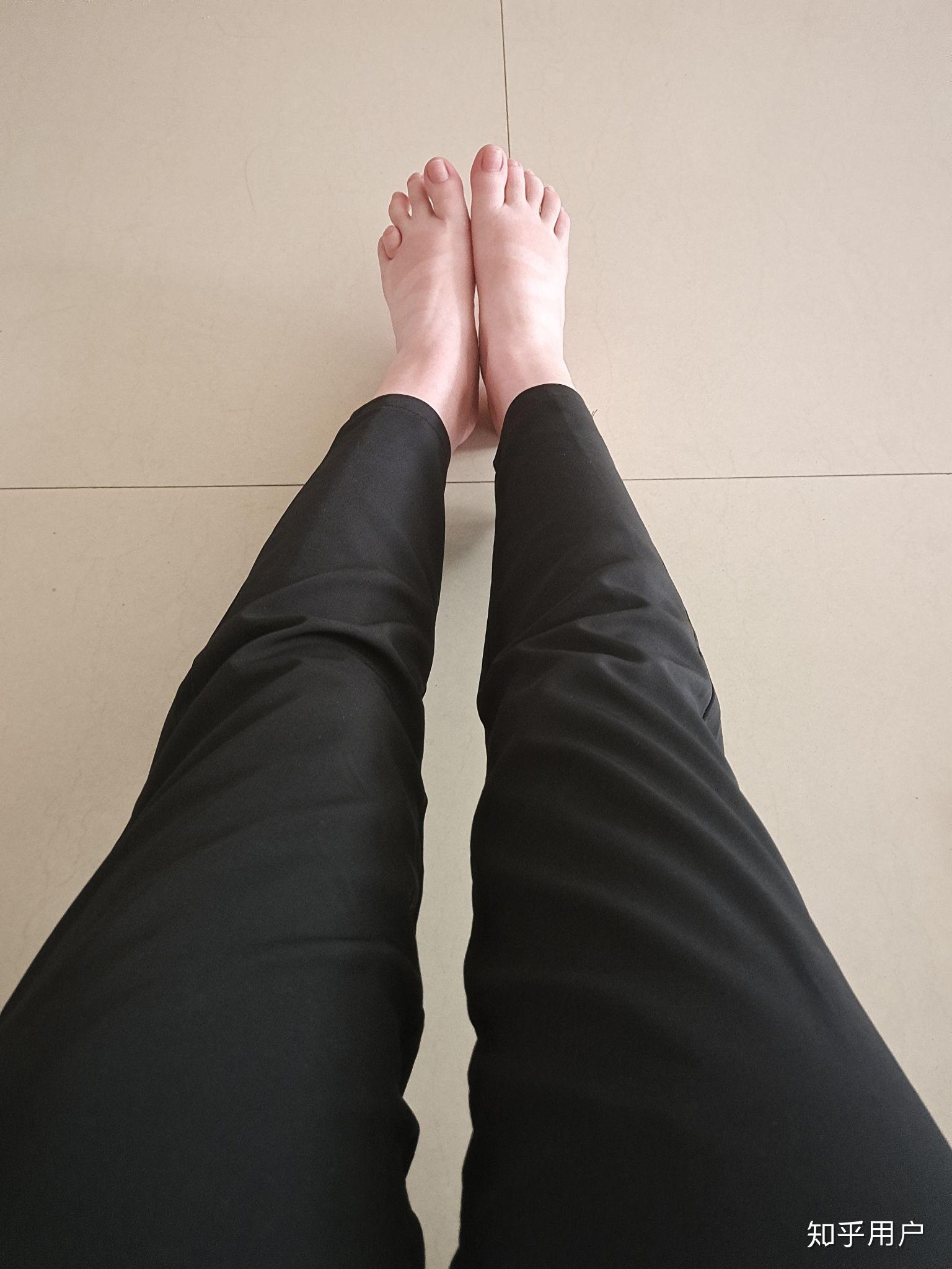 请问大概有多少人是先天性的第四脚趾短小症呢?