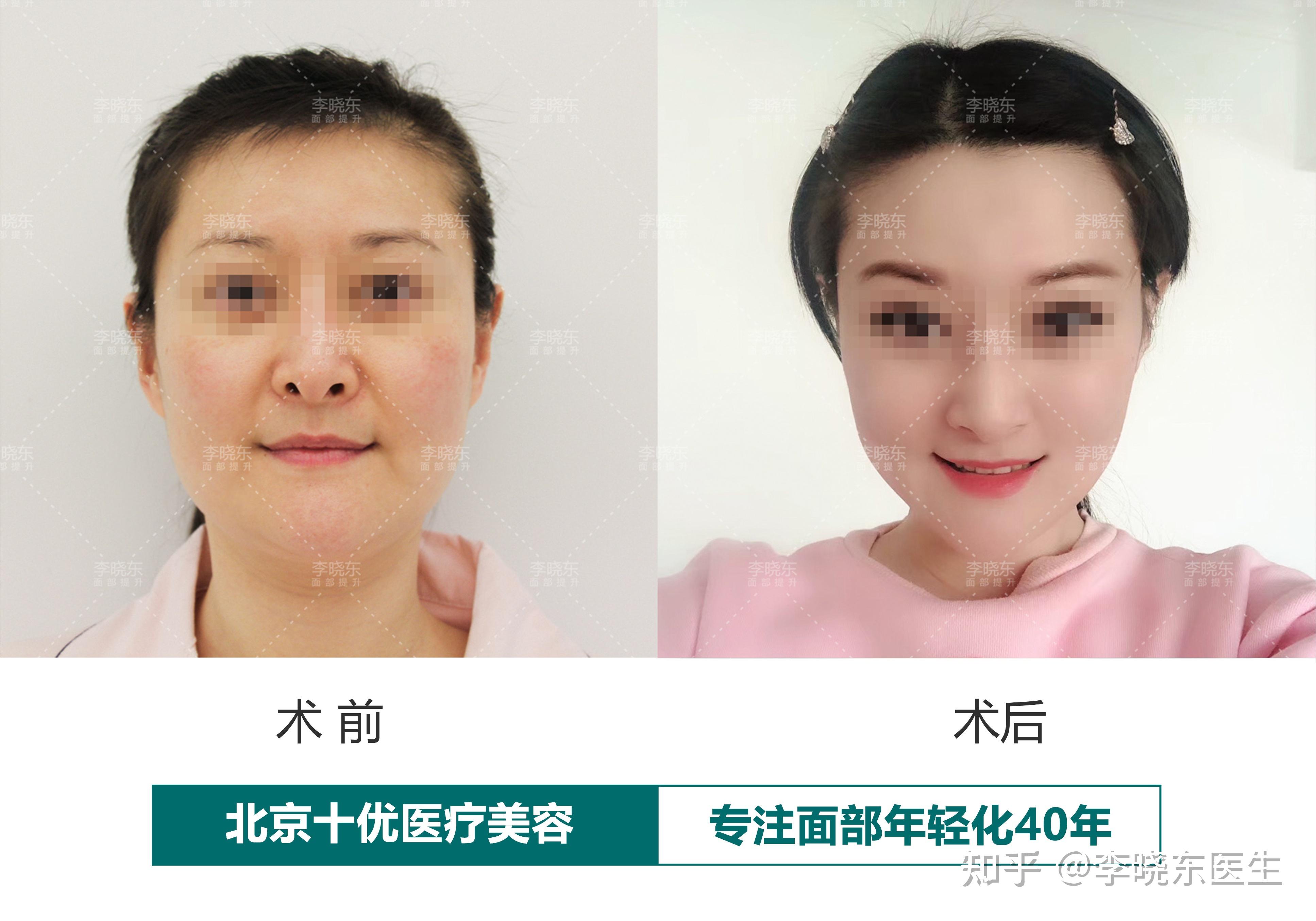 北京面部提升代礼先医生谈面部年轻化－深筋膜拉皮手术能实现哪些面部提升的效果？ - 知乎