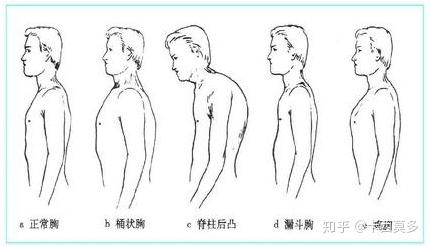 左右胸廓不对称图片图片