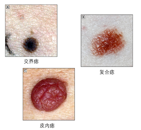 交界痣的特点图片