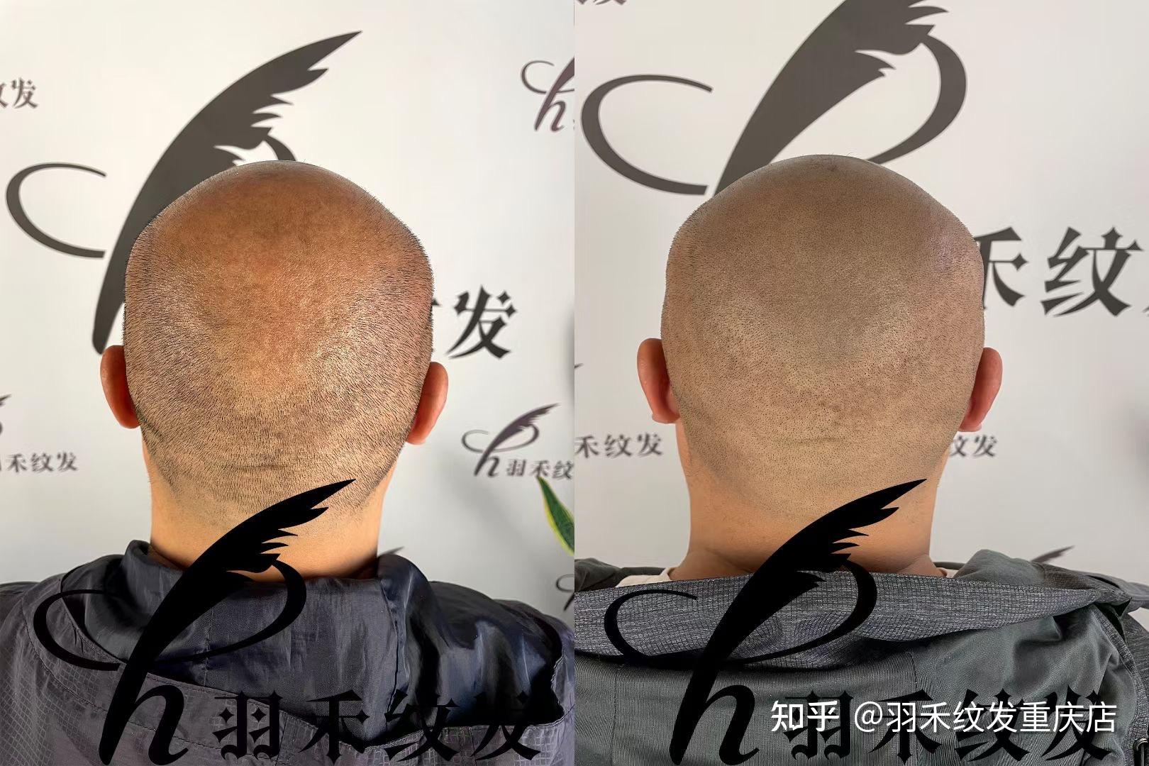 重庆纹发效果好？头顶漩涡处到后脑勺加密，经纹发覆盖露白处，与周边的毛发结合实现伪装，达到正常头发密度 - 知乎