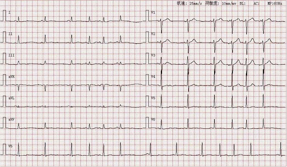 患者男,70岁,因胸闷心悸就诊,图为其心电图结论:窦性心律短阵性房性