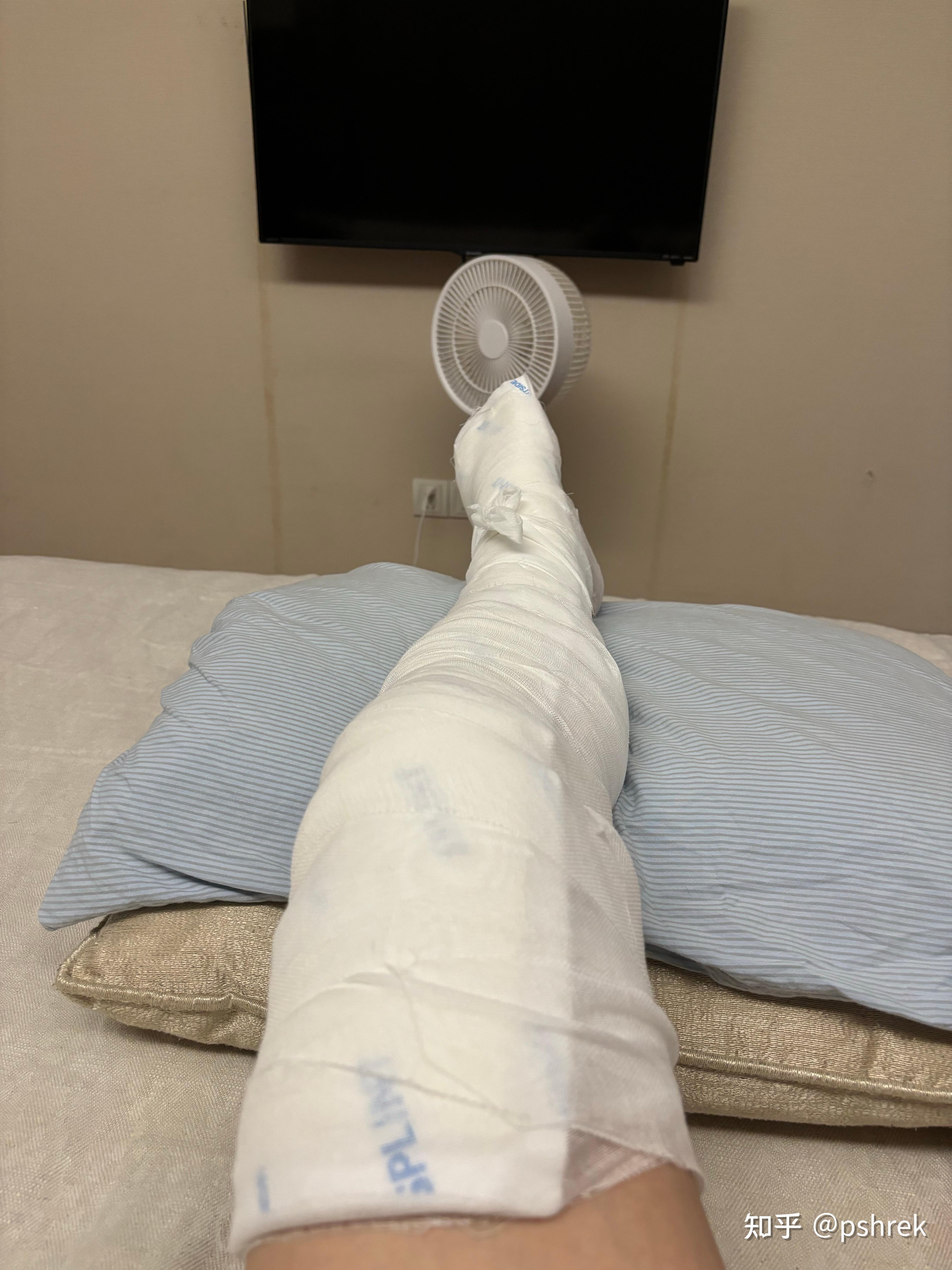 长腿石膏后卧床修养因此我的治疗方案是:保守治疗,石膏固定8周后再次