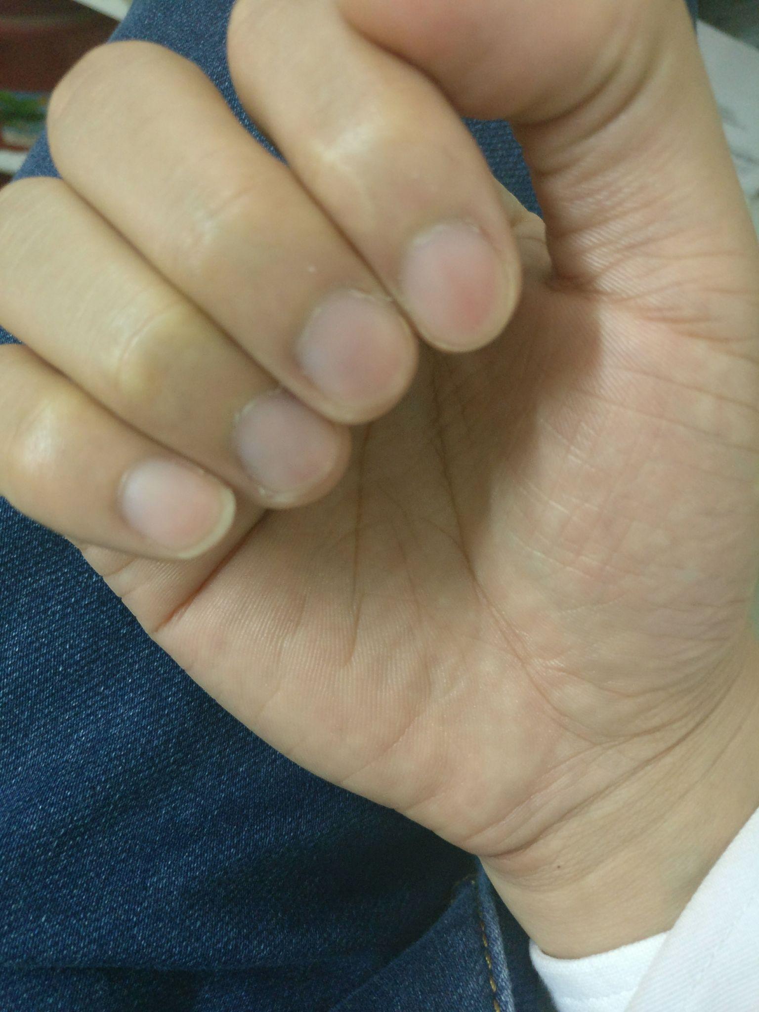 手指头月牙白是否真的能够反应人体健康状态