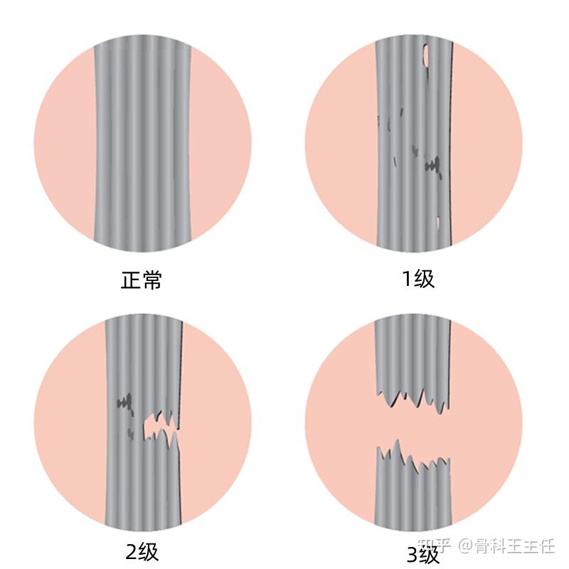 膝盖扭了一下,韧带撕裂分几级,怎么知道严重了? - 知乎