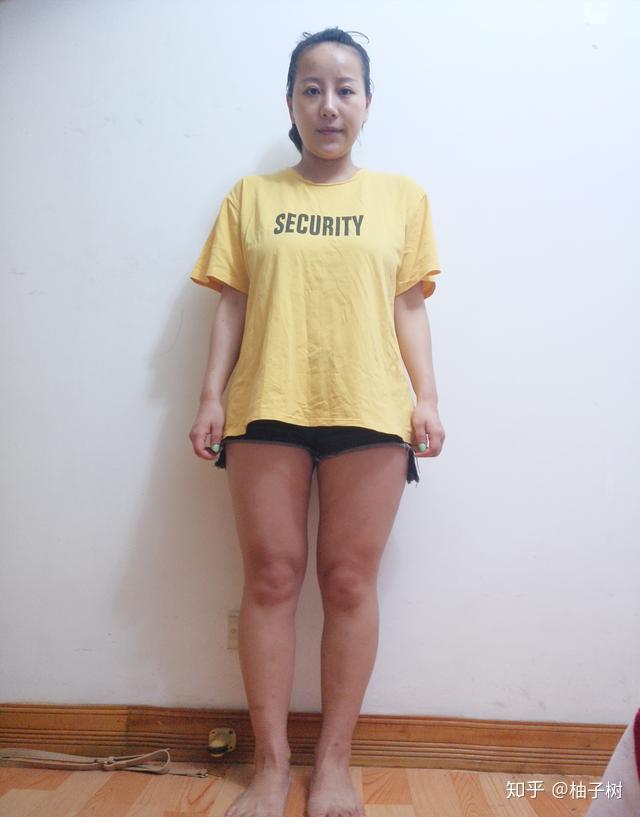 大腿吸脂术后效果瘦瘦的大腿怎么秀谁还不是一枚腿精啦价格25000