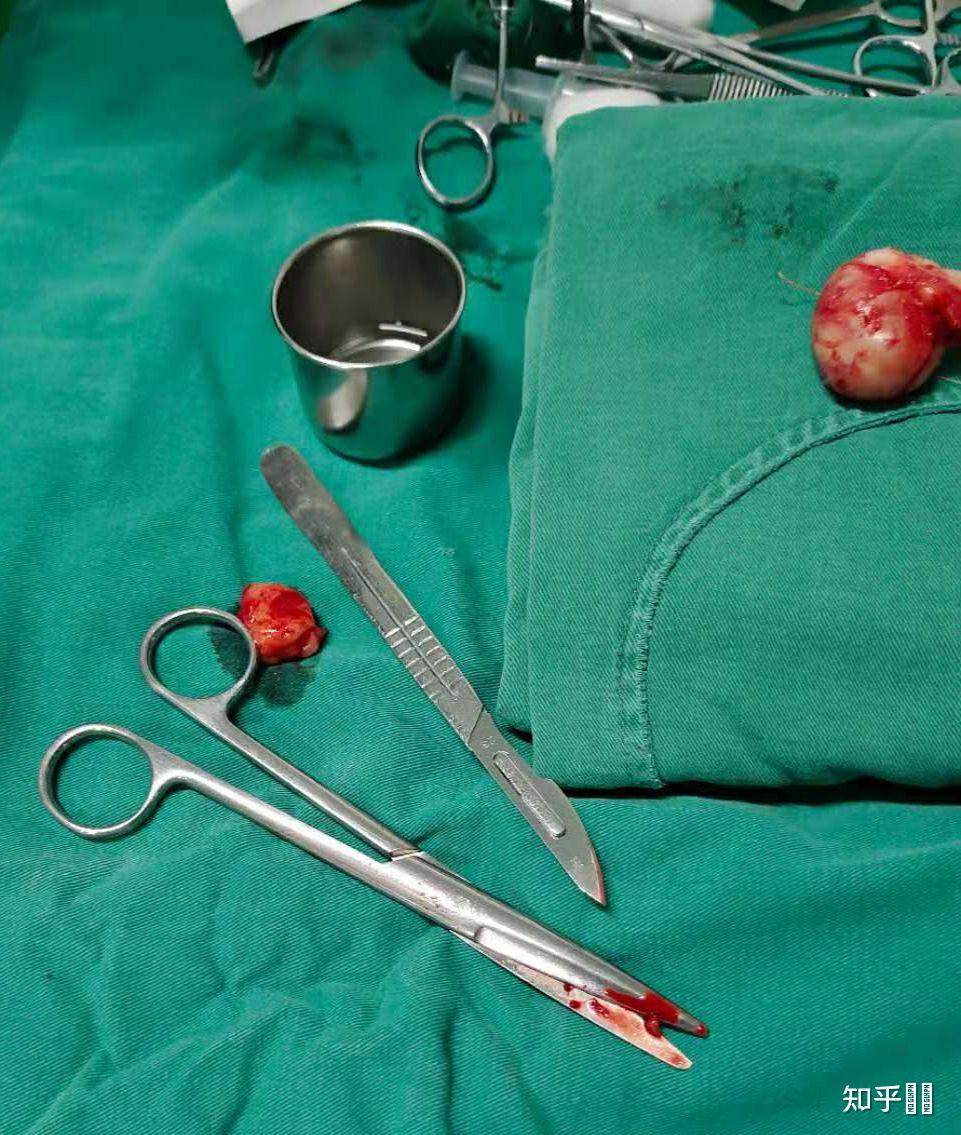 有没有女孩子得过乳腺纤维瘤啊? - 知乎