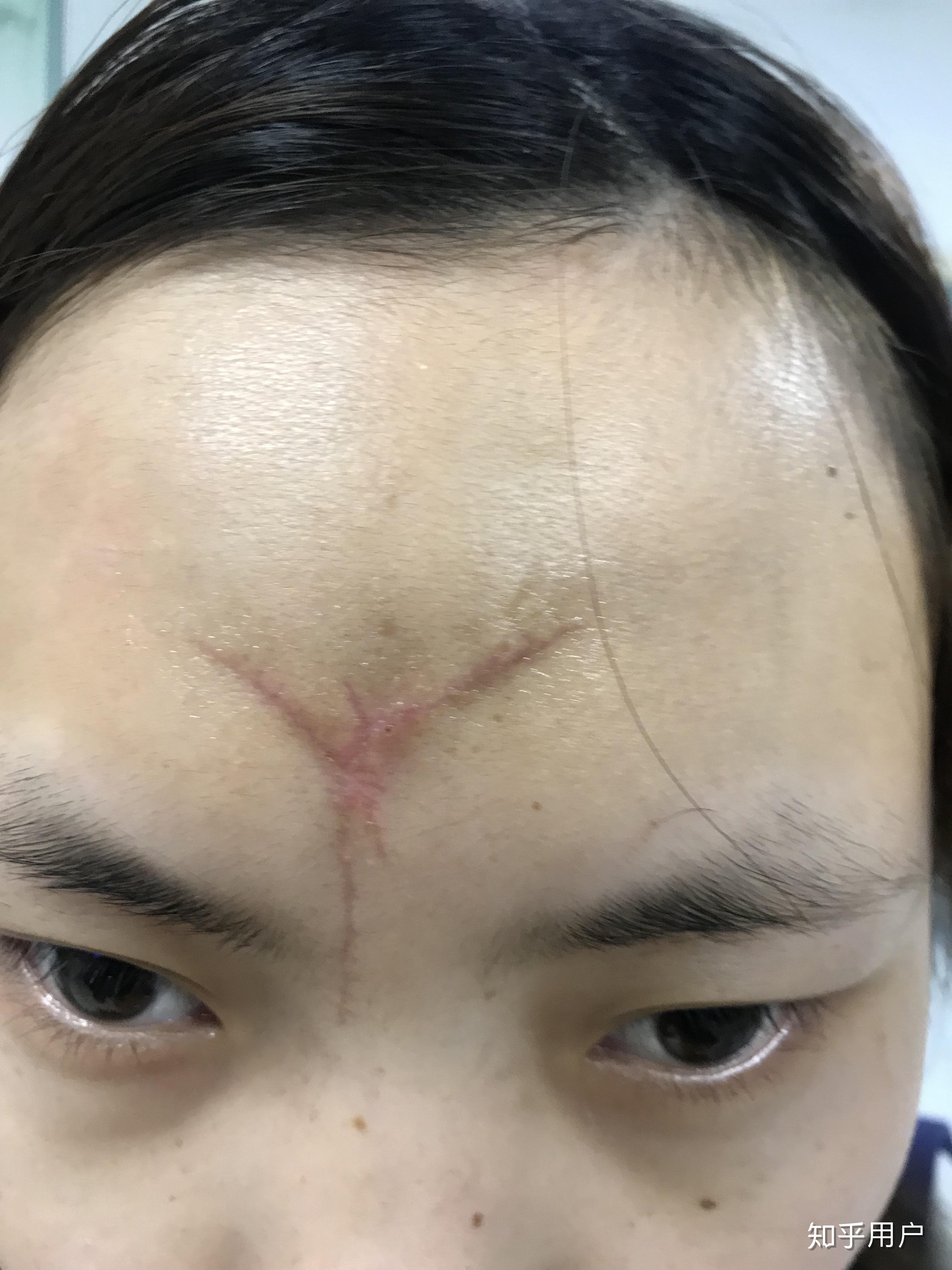 女生脸上有疤是怎样的体验? - 知乎