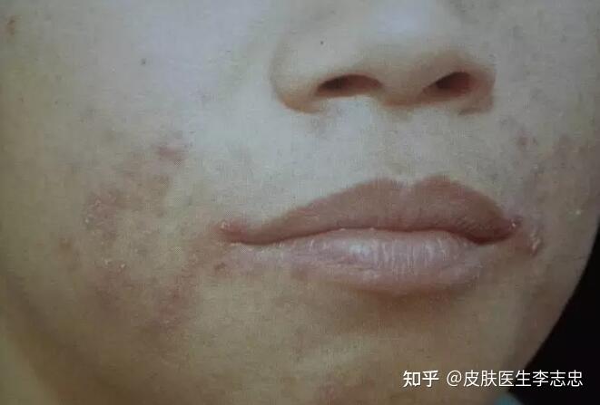 口周皮炎常见的症状有哪些？ - 知乎