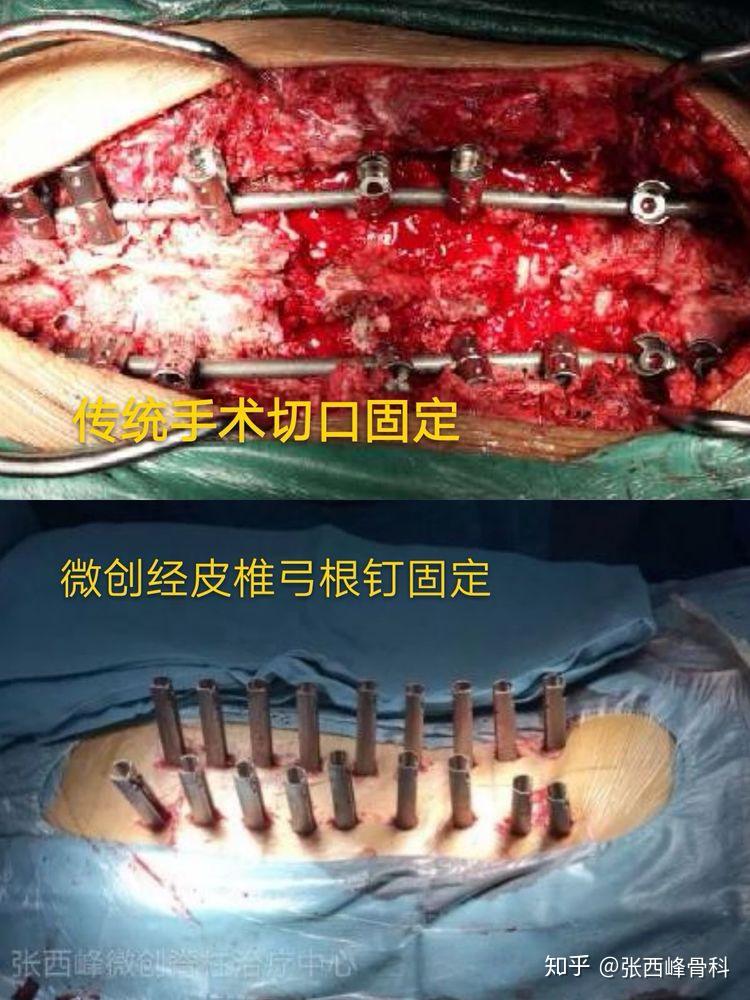 脊柱内镜辅助下椎间融合经皮椎弓根钉固定治疗退行性脊柱侧弯 - 知乎