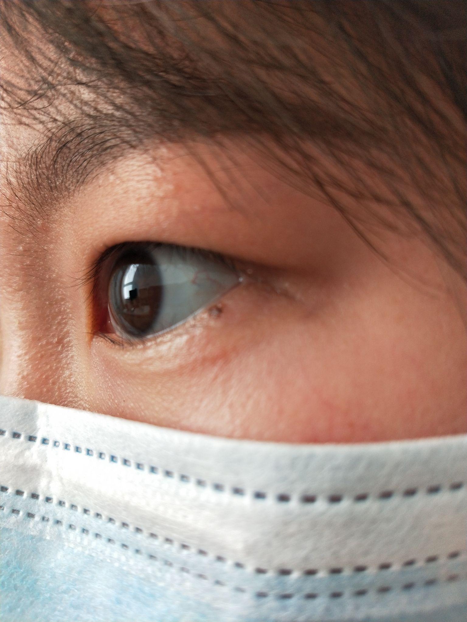 为什么我的眼白会是蓝色天生就是这样