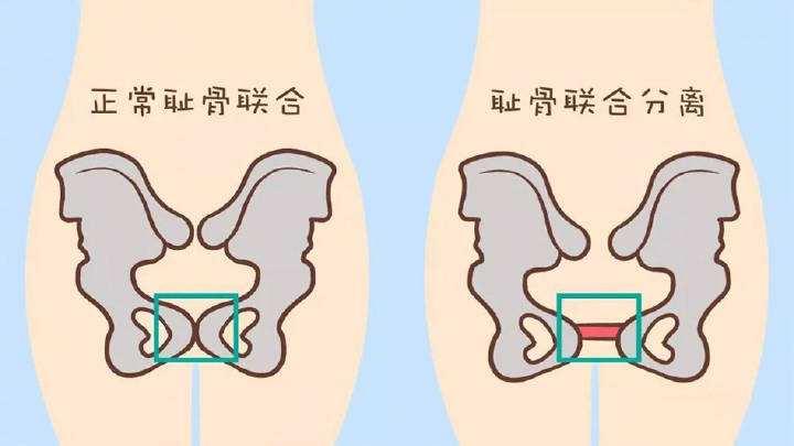 孕期这种痛 痛到让你不能下床 30 的准妈妈都经历过 知乎 孕期这种痛 痛到让你不能下床 30 的准妈妈都经历过 知乎