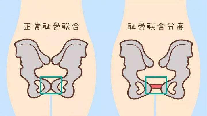 孕期这种痛 痛到让你不能下床 30 的准妈妈都经历过 知乎