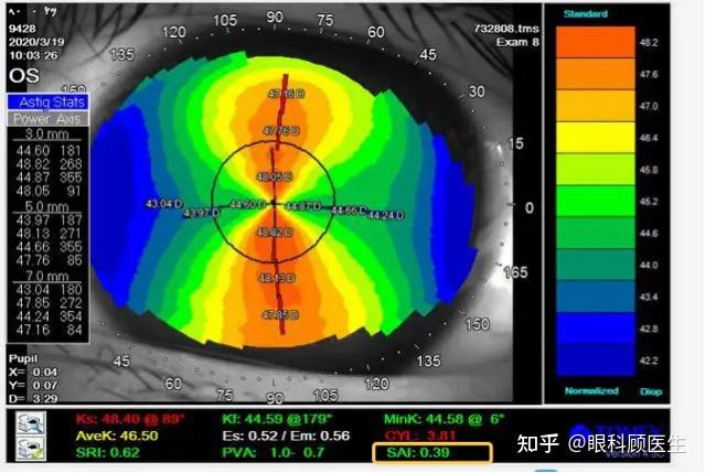 常见角膜地形图图片