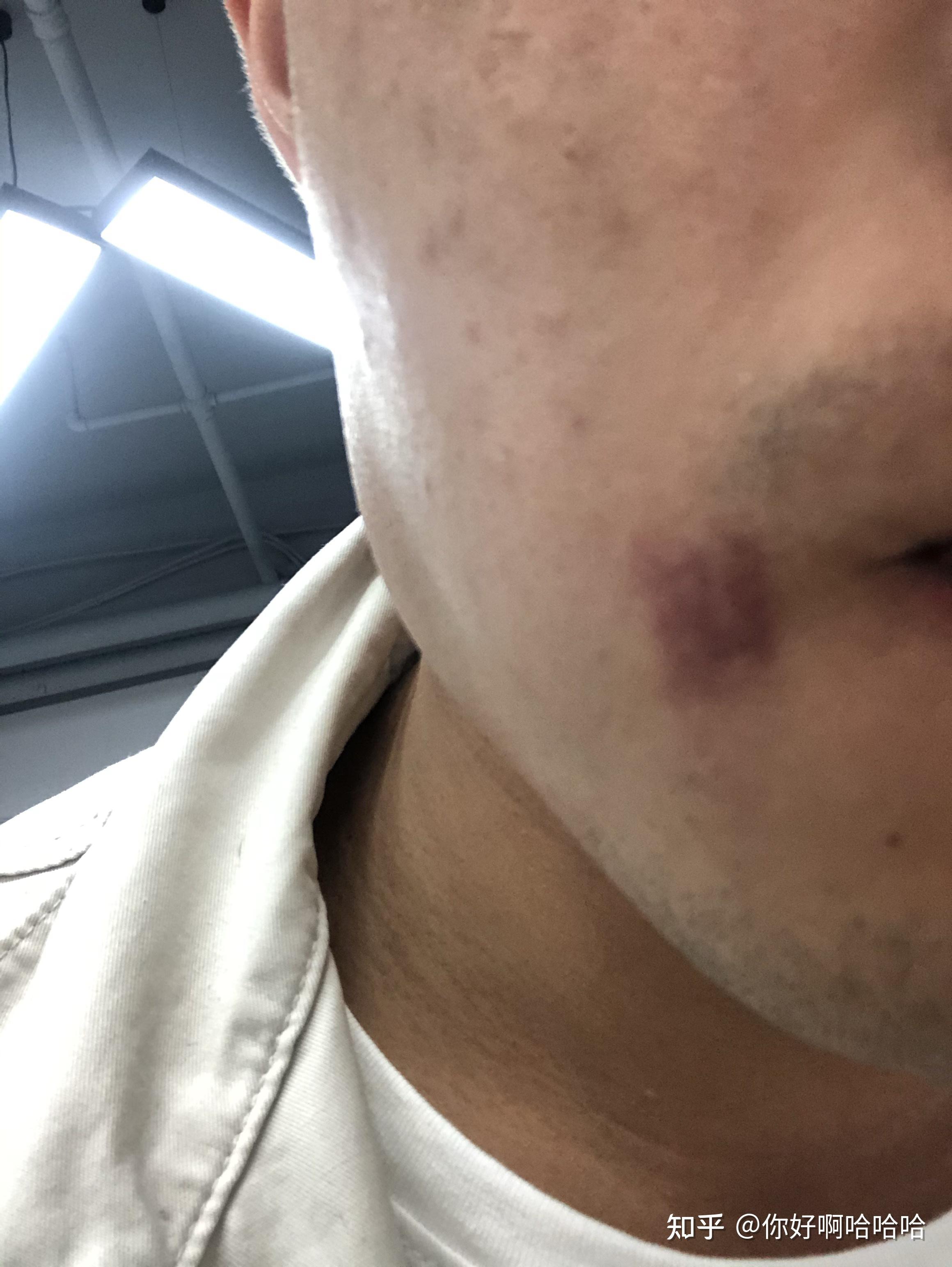 嘴角突然出现一块红斑,怎么回事 - 知乎