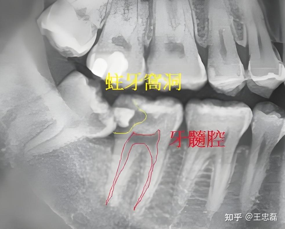 牙齿深龋需要根管治疗吗? - 知乎