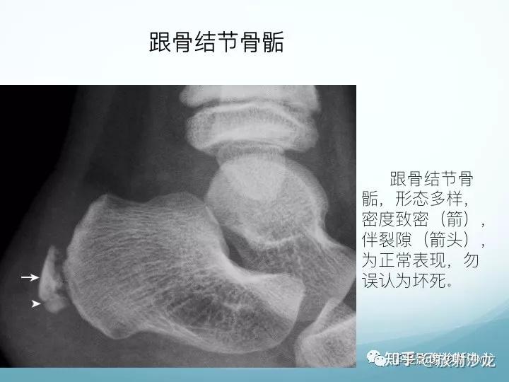 千萬別把這23種足部變異誤診為病變