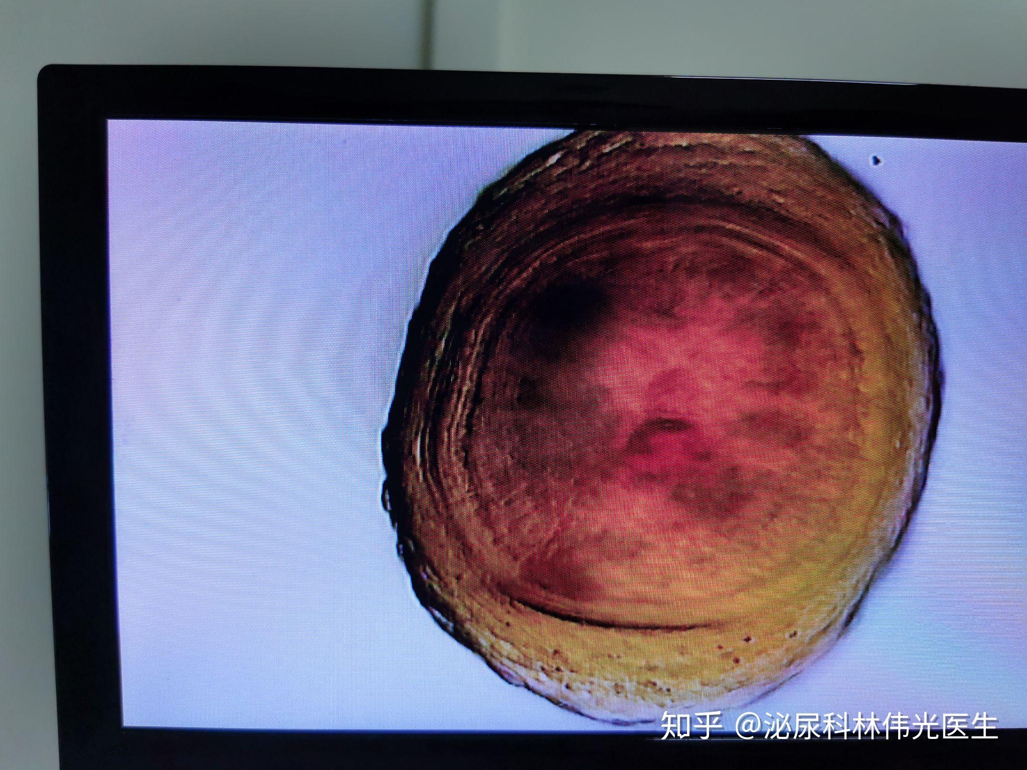 二十岁大学生检查出来前列腺钙化灶该怎么办? - 知乎