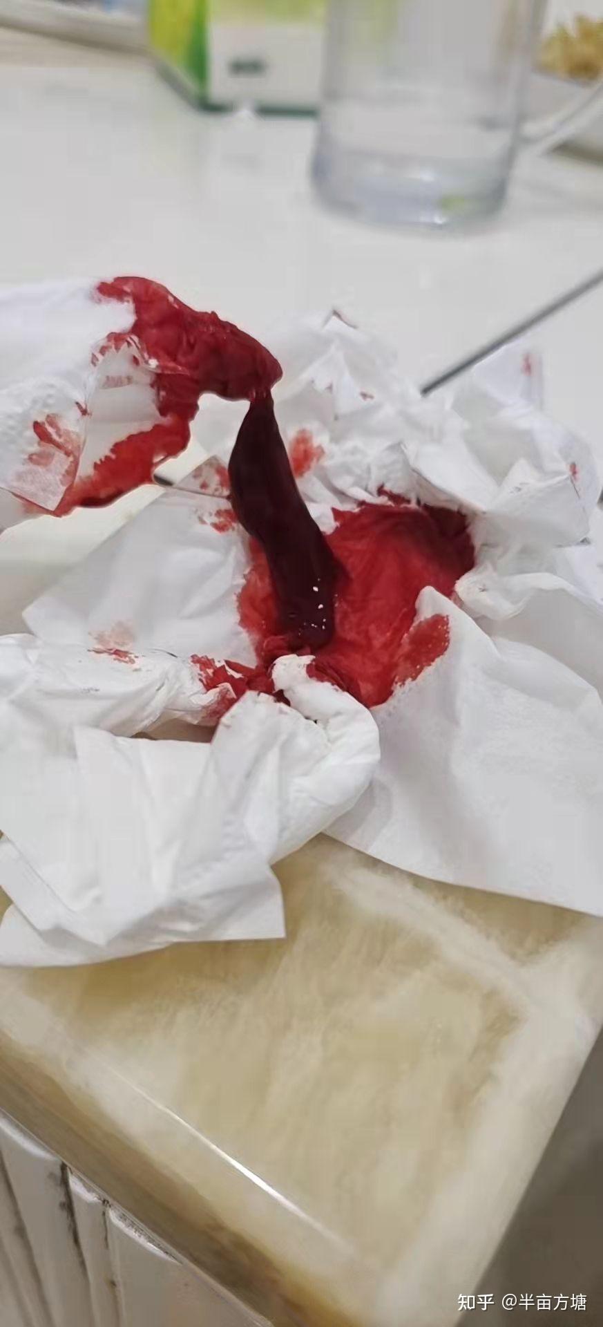 鼻衄失败案例 - 知乎