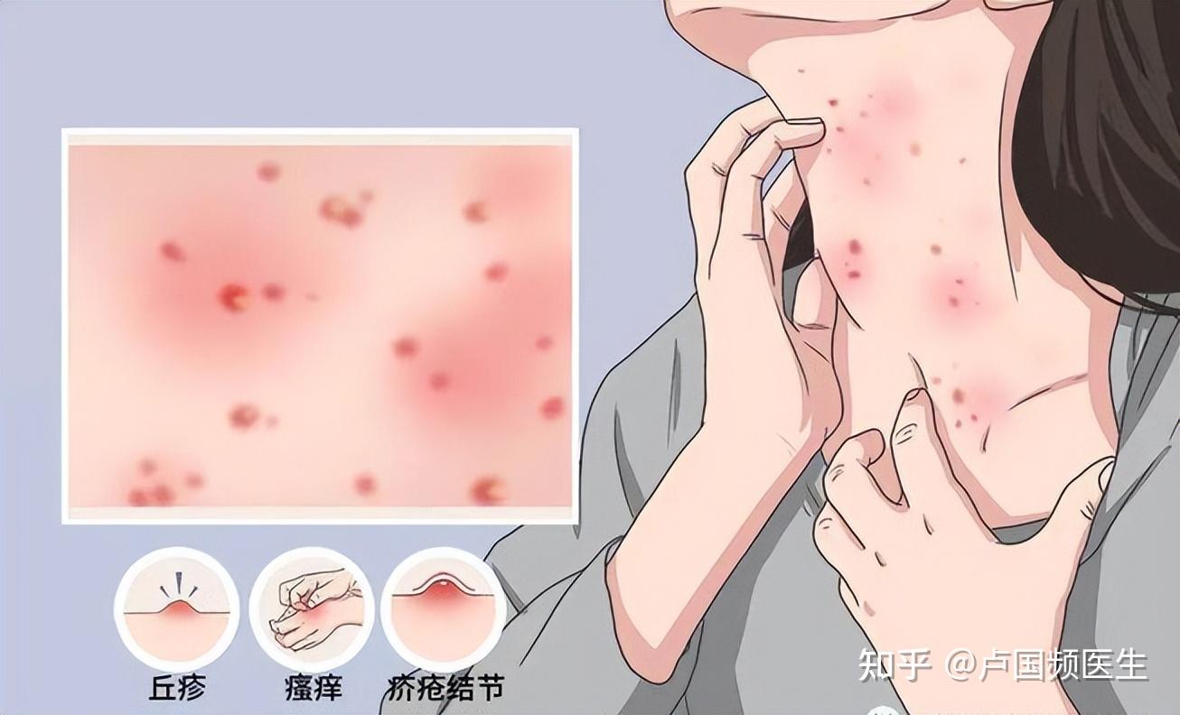 一种不太要命,但不治疗又十分磨人的皮肤病——毛囊炎! - 知乎