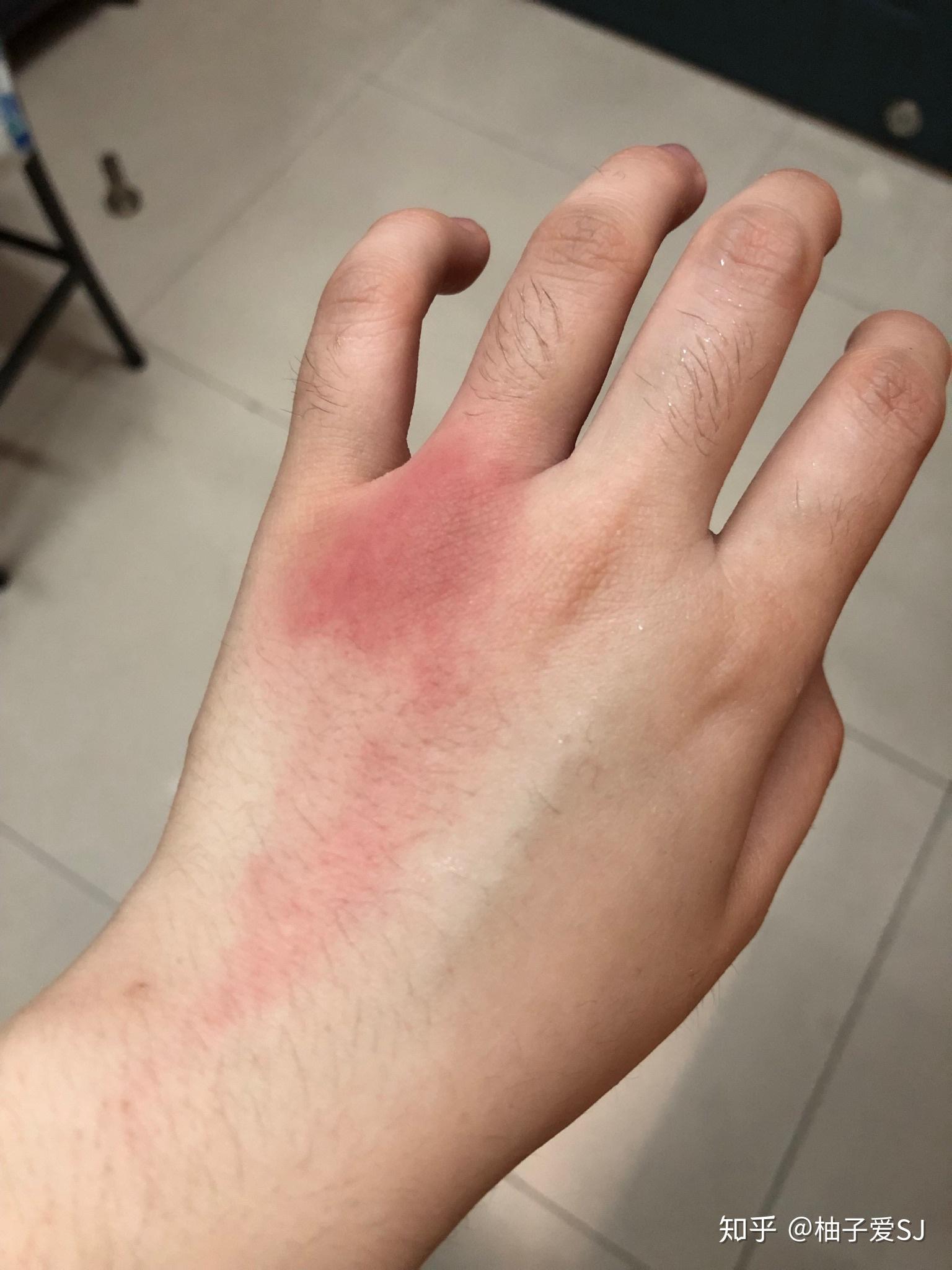 蚊子咬完就过敏怎么破