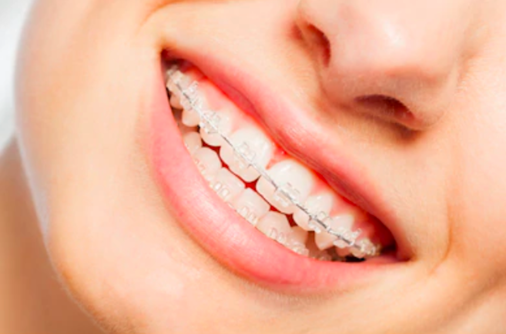产品中心-易齐美公司官网-牙齿隐形矫正,矫治/矫治器/牙套/口腔正畸