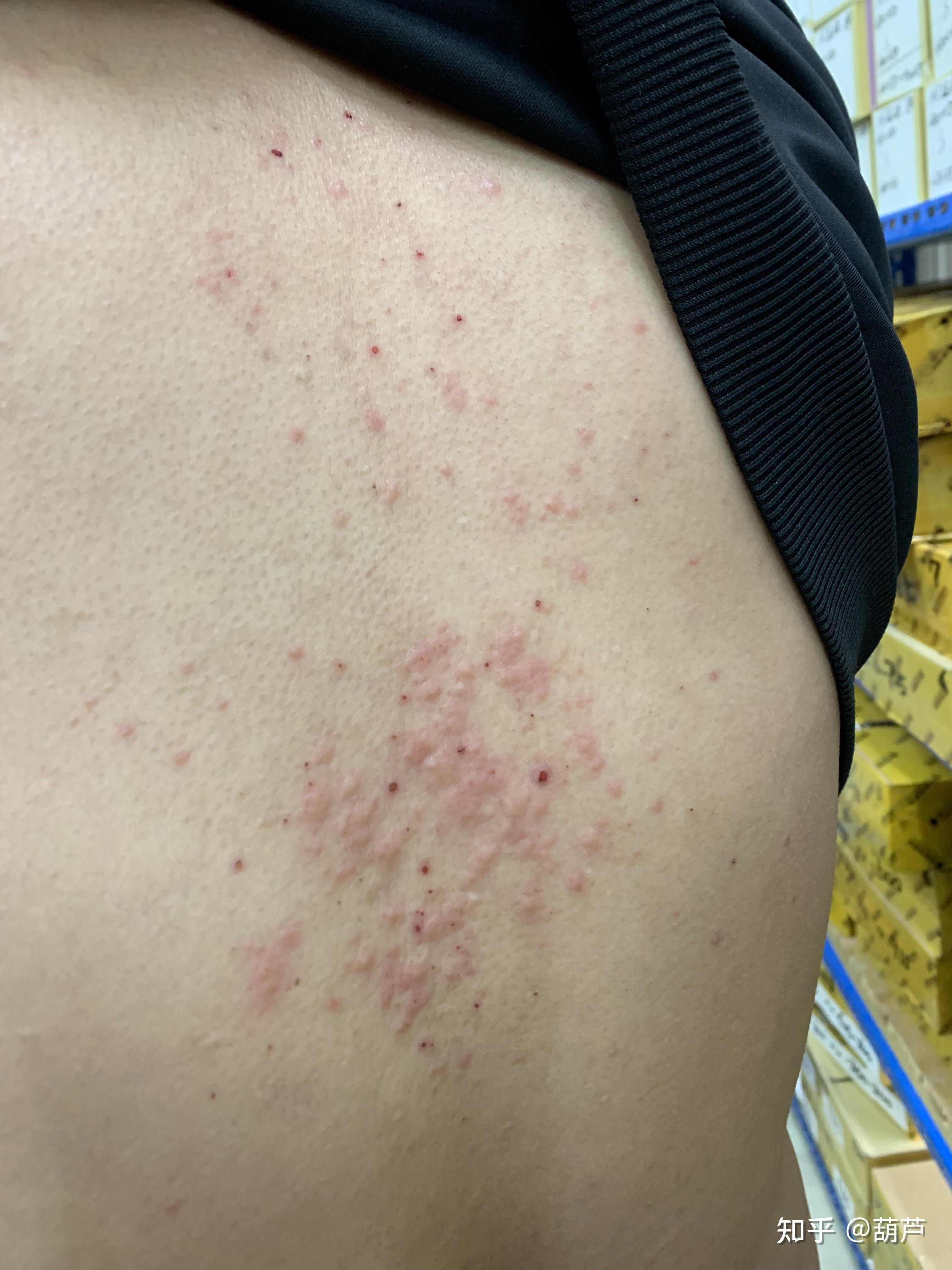 背上长了很多痘痘 很痒 是什么原因? - 知乎
