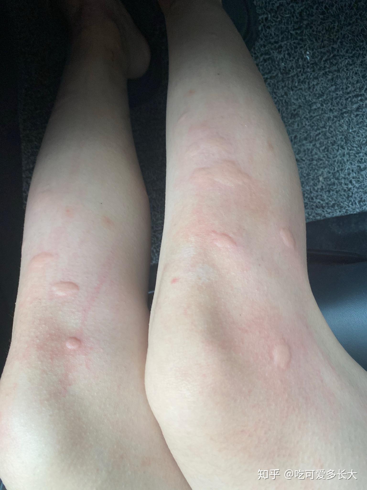 在南方,被毒蚊子咬是一种怎样的体验? - 知乎