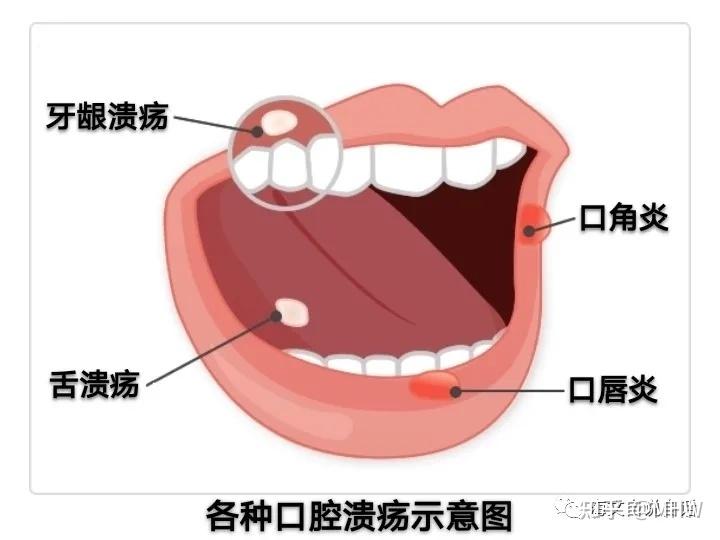 口腔为何会溃疡