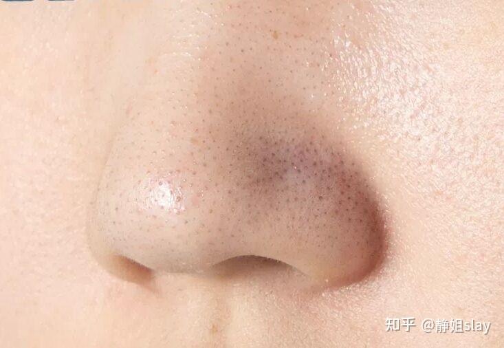 闭口黑头毛孔给我爬穷学生小白都可以放心操作的刷酸教程让你素颜都被