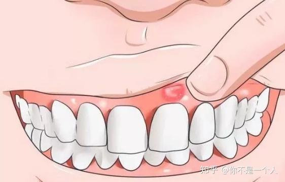 廣州聖貝口腔提醒牙齦上的小膿包不管不顧可不行