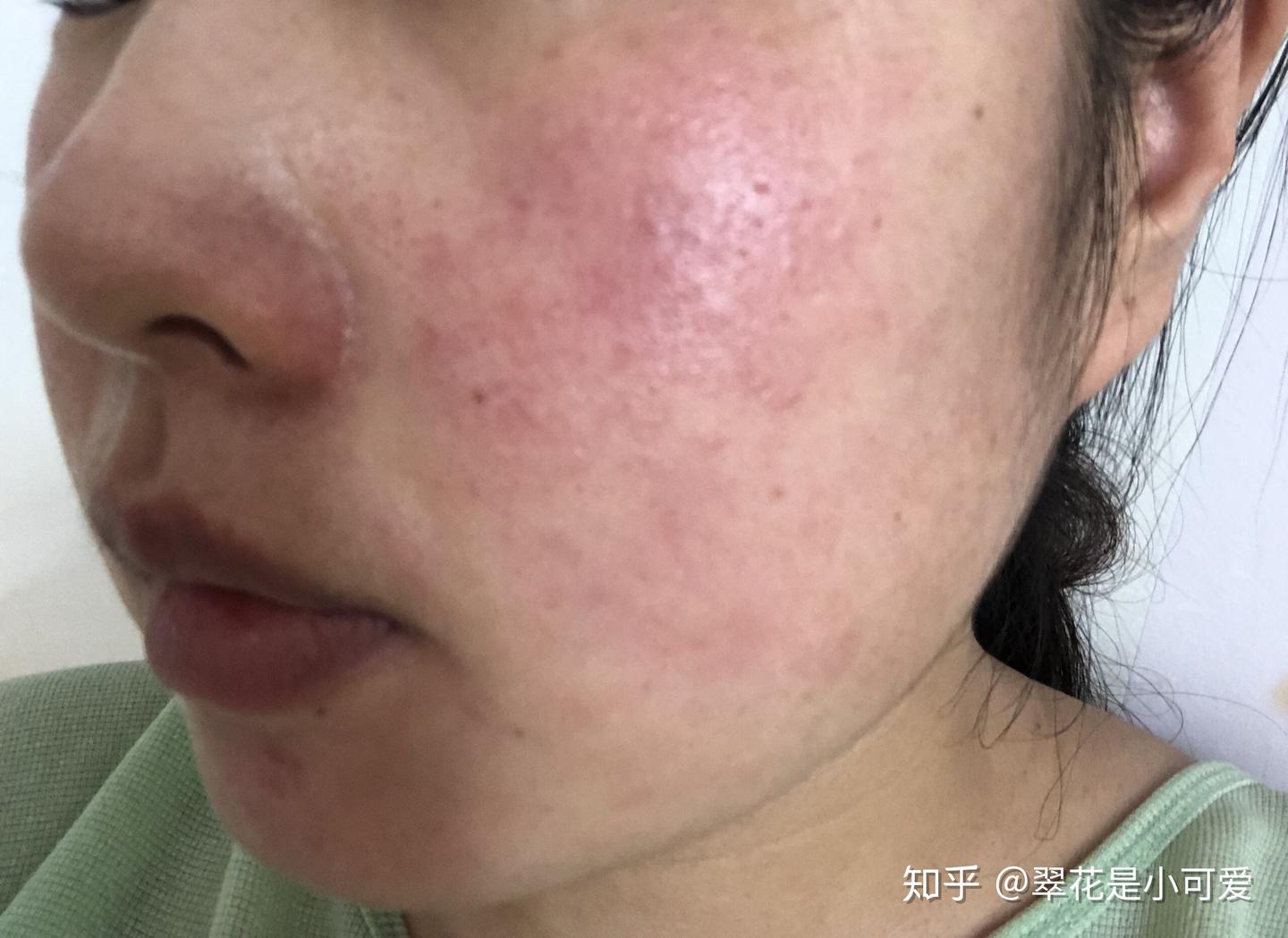 过敏性面部皮炎 - 知乎