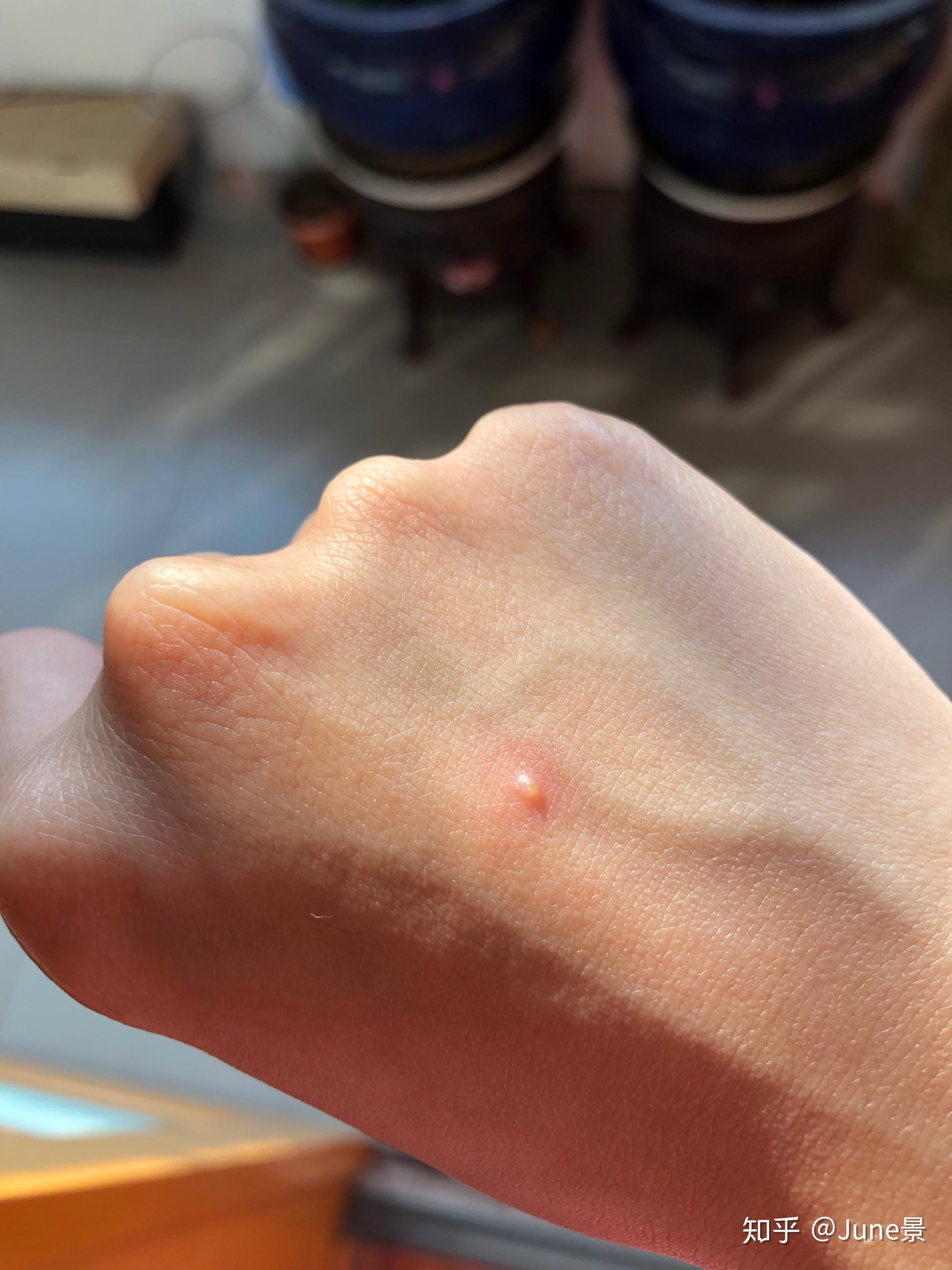 发一张长在手上晶莹剔透的小水痘吧回到家老妈给我身上的水痘(主要是