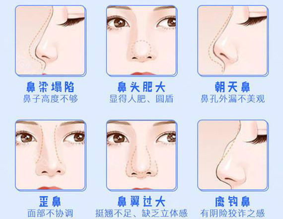 很抱歉 你的鼻假体必须取出 知乎 很抱歉 你的鼻假体必须取出 知乎