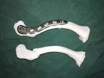 上肢骨折与脱位 笔记 知乎