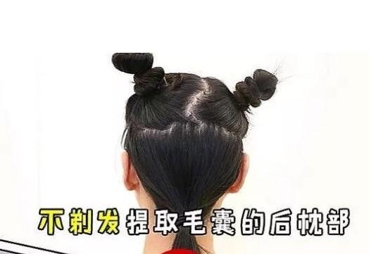 植发6个月脱发怎么办(植发六个月后还会继续浓密吗)