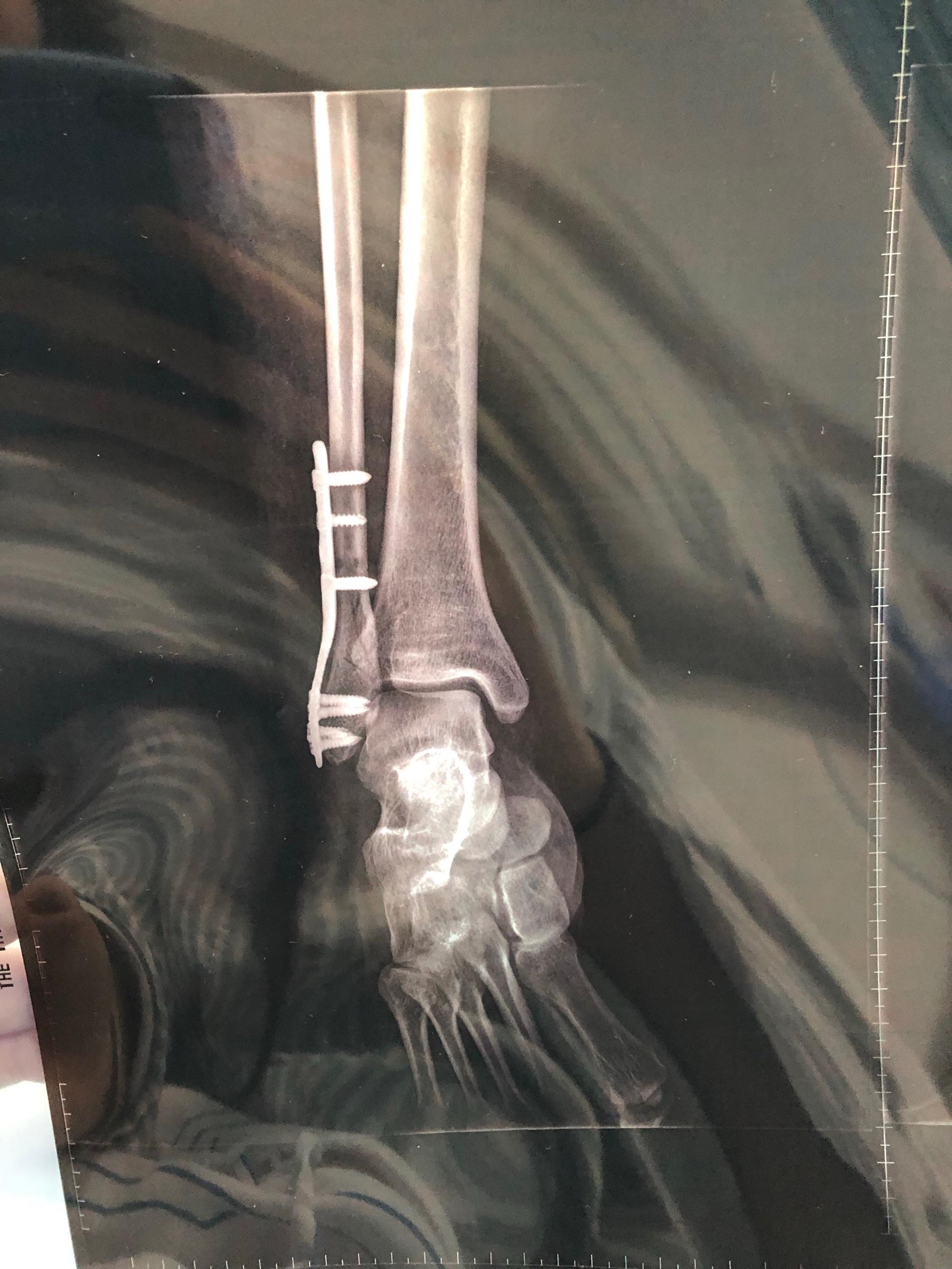 右脚脚踝骨折x光图片图片