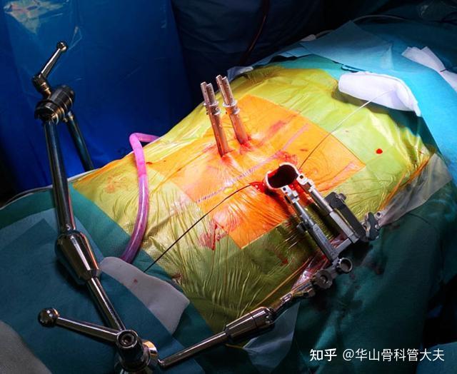 小开窗手术就是椎板开窗髓核摘除术,还有椎板开窗髓核摘除术是微创