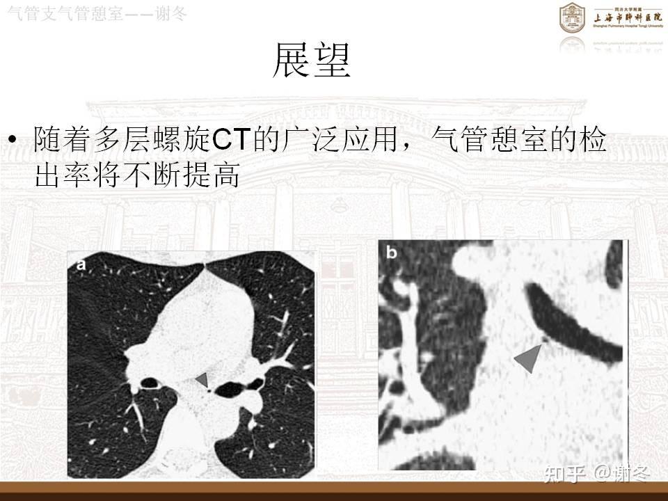气管憩室是什么疾病需不需要治疗