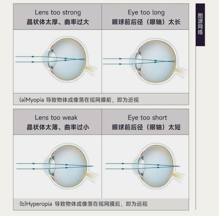 一,认识眼睛近视远视的成因