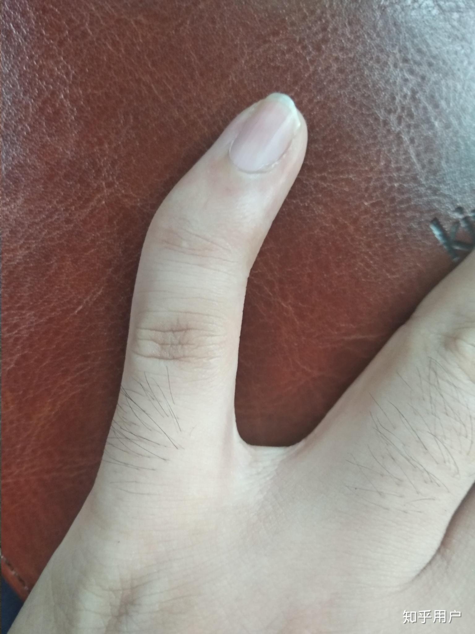 为什么小拇指是弯的