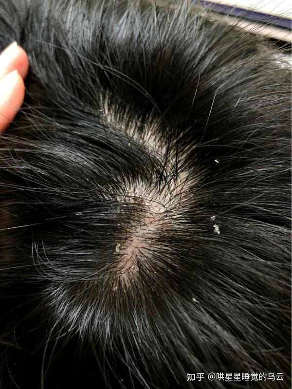如果男生头屑一直洗不干净、头发还经常出油,不妨听听我的建议 - 知乎