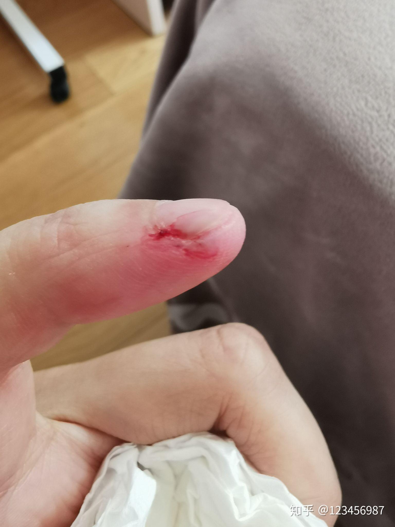 切菜的时候把手指甲切掉了一半血流不止,英国的医生只用温水冲了一下