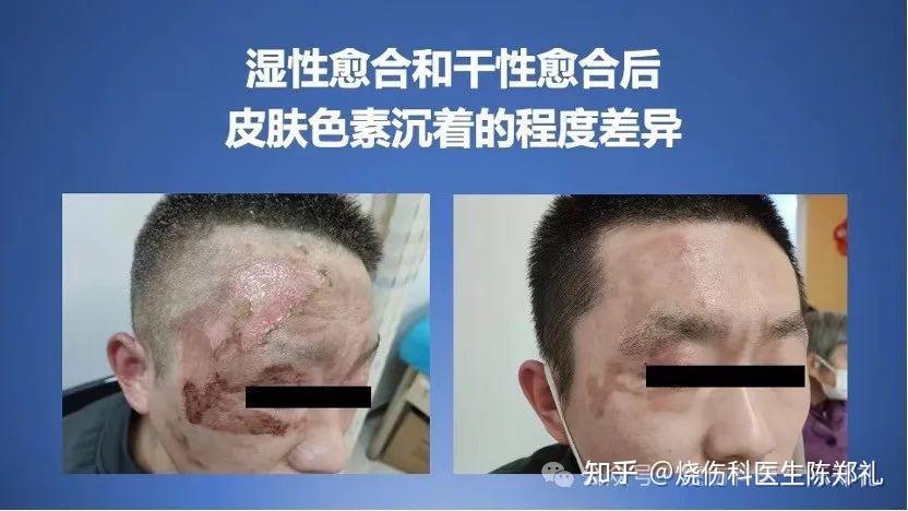 什么样的伤口能碰水? - 知乎