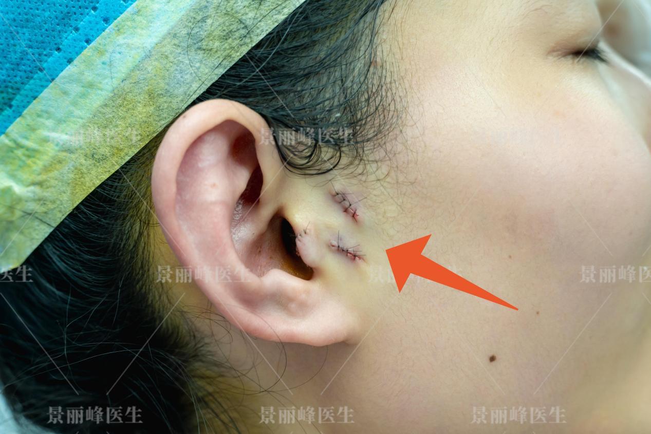 有副耳的人必看附耳切除前后的注意事项