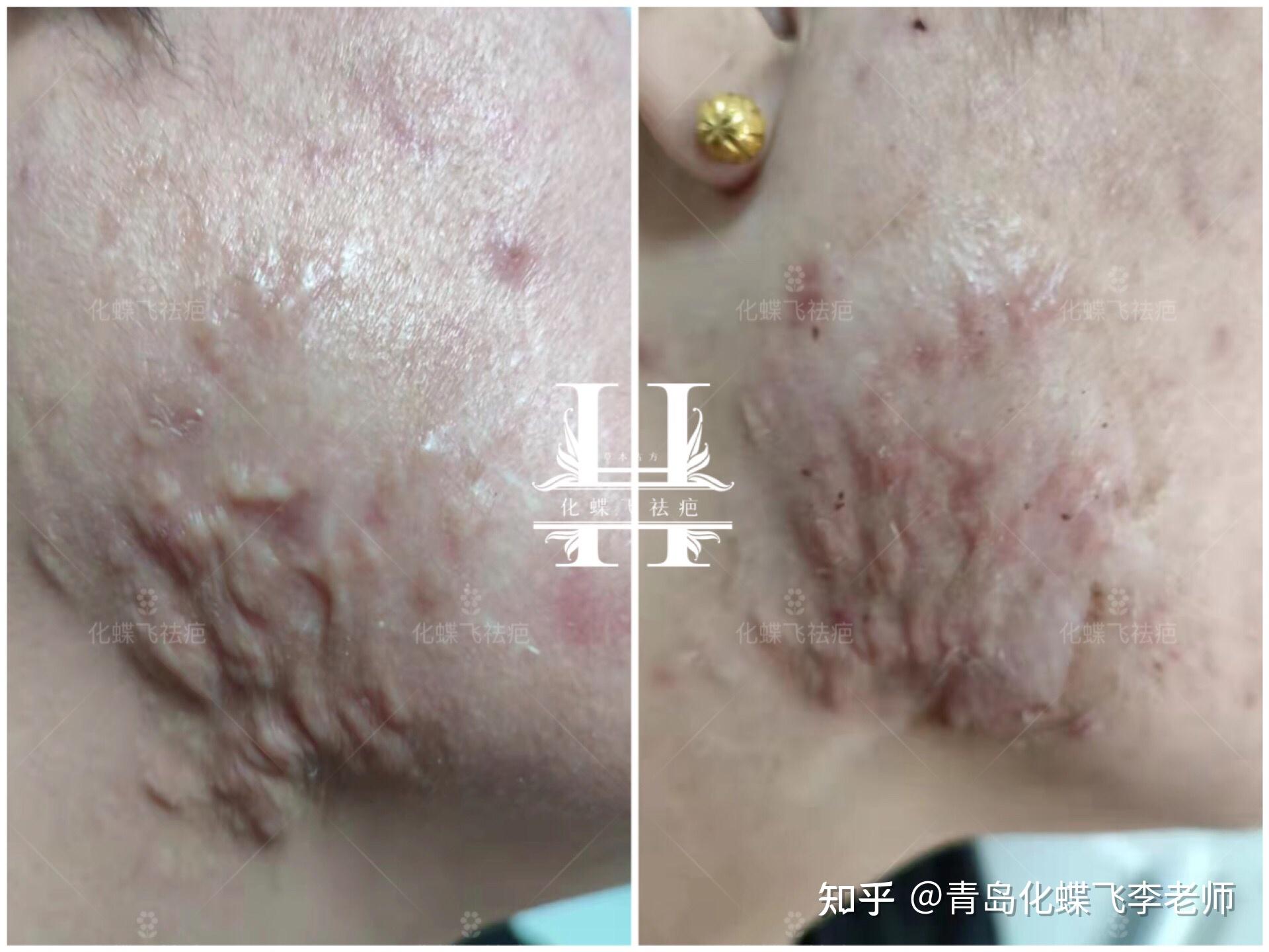 严重的痤疮结节修复