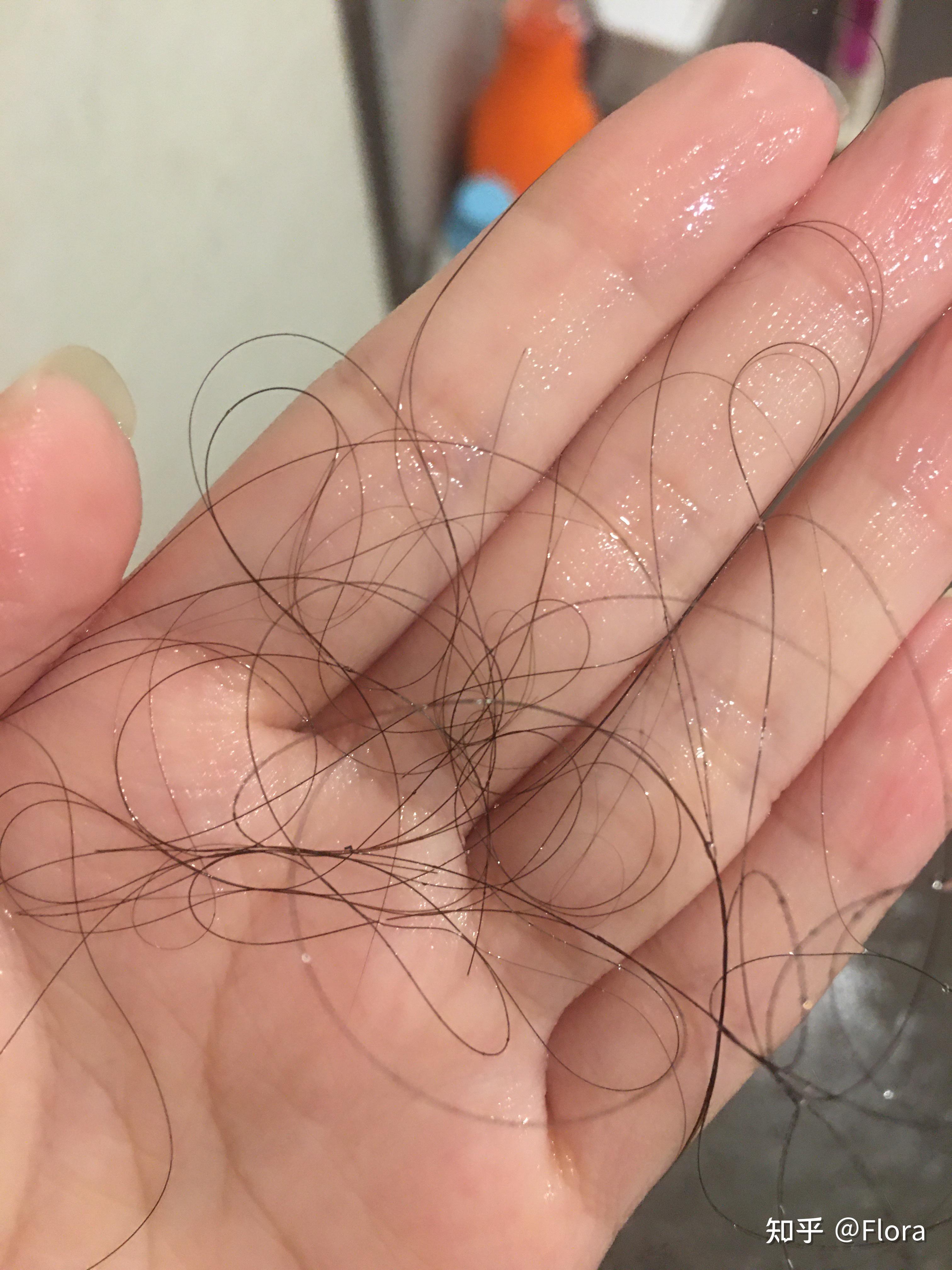 救救孩子吧大二女生掉很多头发都快秃了怎么办有没有什么方法或者管用